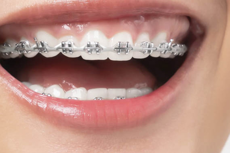 Microimplantes