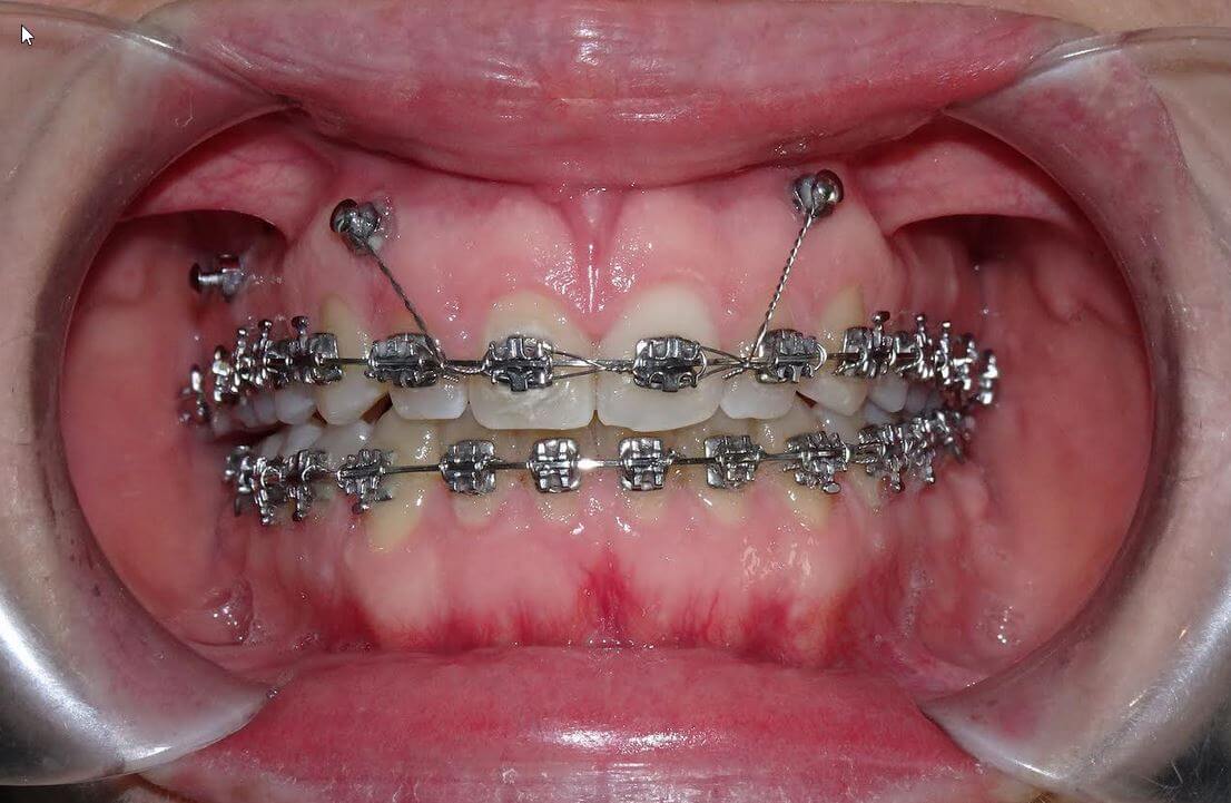 Microimplantes
